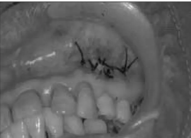 Fig. 1. The open wound around the apicoectomy site of the maxillary left first premolar