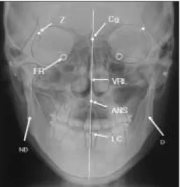 Fig. 2. Reference Points on Submentovertex view Abbrev.