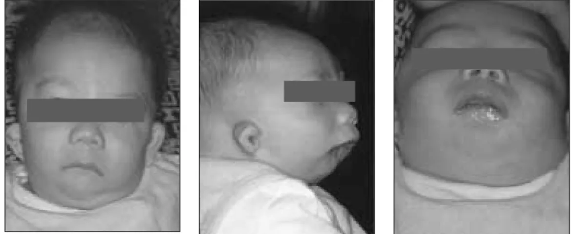 Fig. 4. Postoperative frontal, lateral, and Worm's eye views at 6 months of age.