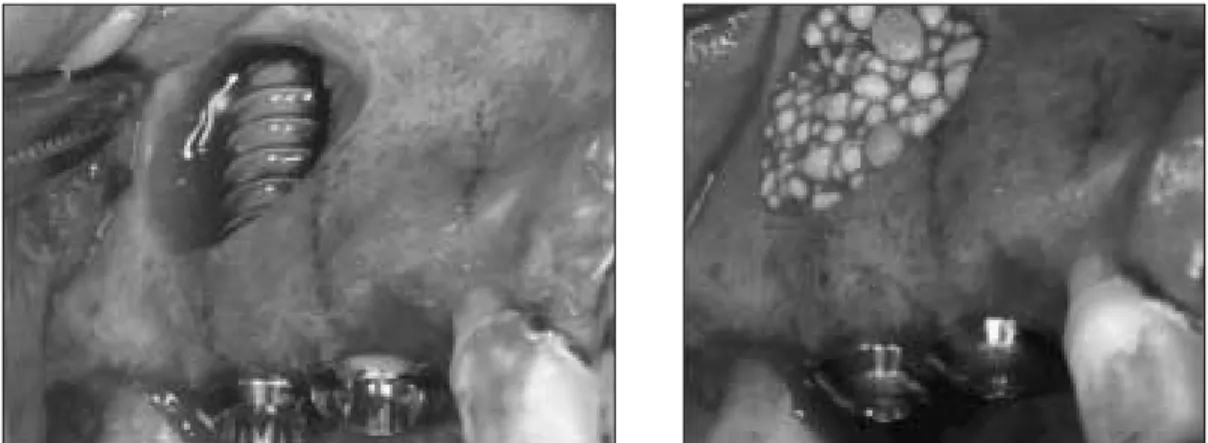 Fig. 3. The mucosal suture was done like as non-submerged type.