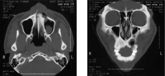 Fig. 6. CT  scans  showing  bony  defect  on  left  anterior  maxilla  with  infiltrative  growth tendency to the surrounding structures.