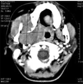 Fig. 5. 1) CT  scan  showing  destruction  of  lateral  ptery- ptery-goid process
