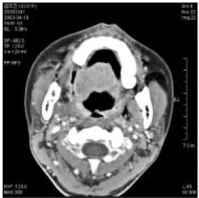 Fig. 7. Follow-up  Ct  scan  showing  removed  state  on Rt. pterygoid m. area.
