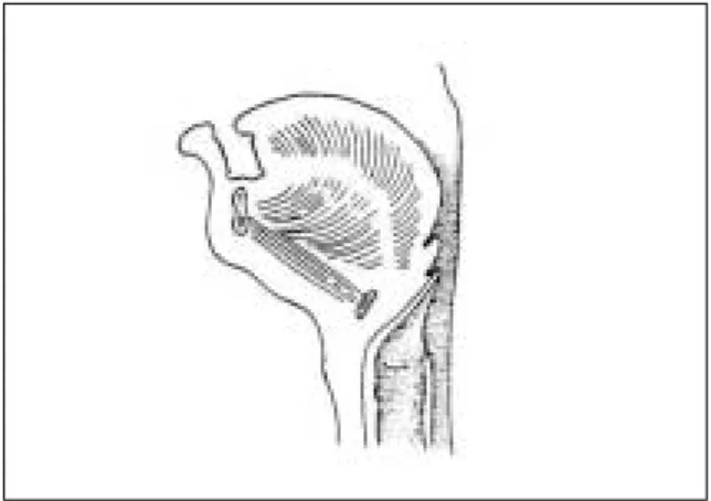 Fig. 4. Typical position of the tongue in an infant with Pierre Robin sequence.