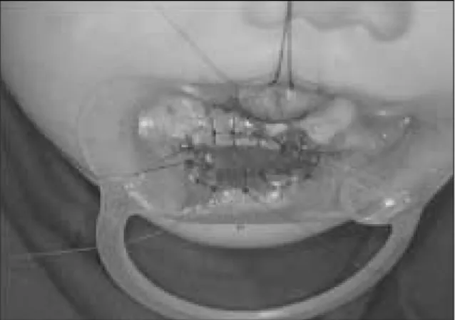 Fig. 13. Intraoperative  view  showing  tongue-lip  separation using Terudermis graft at 11 months of age