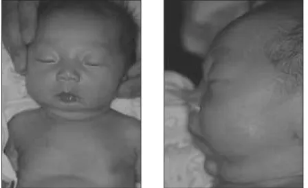 Fig. 16. Preoperative frontal and lateral photographs at 7 days of age.   