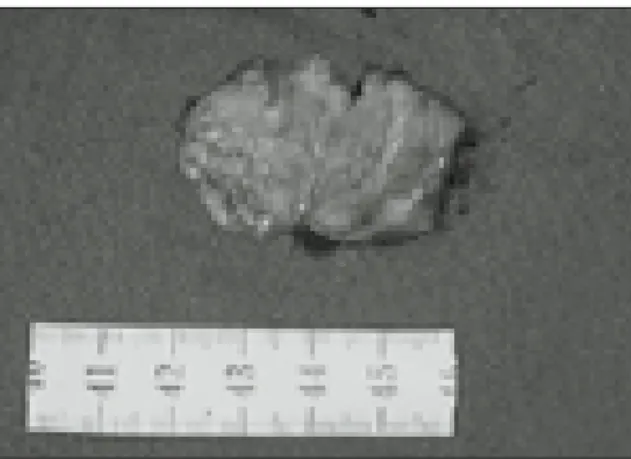 Fig. 8. Histologic  section  of  the  pleomorphic adenoma  showing  ductal  epithelium,  squamous metaplasia  and  necrotic  area