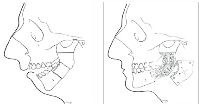 Fig. 1. The Obwegeser II method procedure for the correction of very severe open bite case (Obwegeser 1964) 3) .