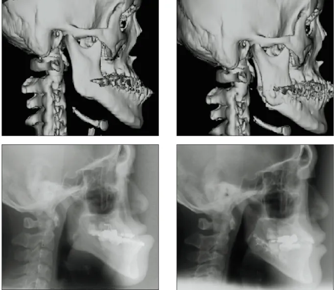 Fig. 2. Lateral  cephalogram  &amp;  3-D  CT  image  of  pre-  and  postoperative  state  by  Obwegeser  II  method  using fixation with miniplates of severe prognathic &amp; open-bite case