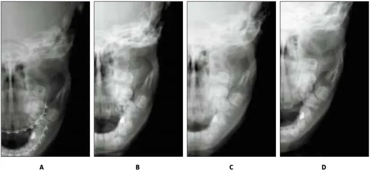 Fig. 4. Reverse  Towne’s  view  of  the  left  condylar  fracture  in  a  7-year-old  girl