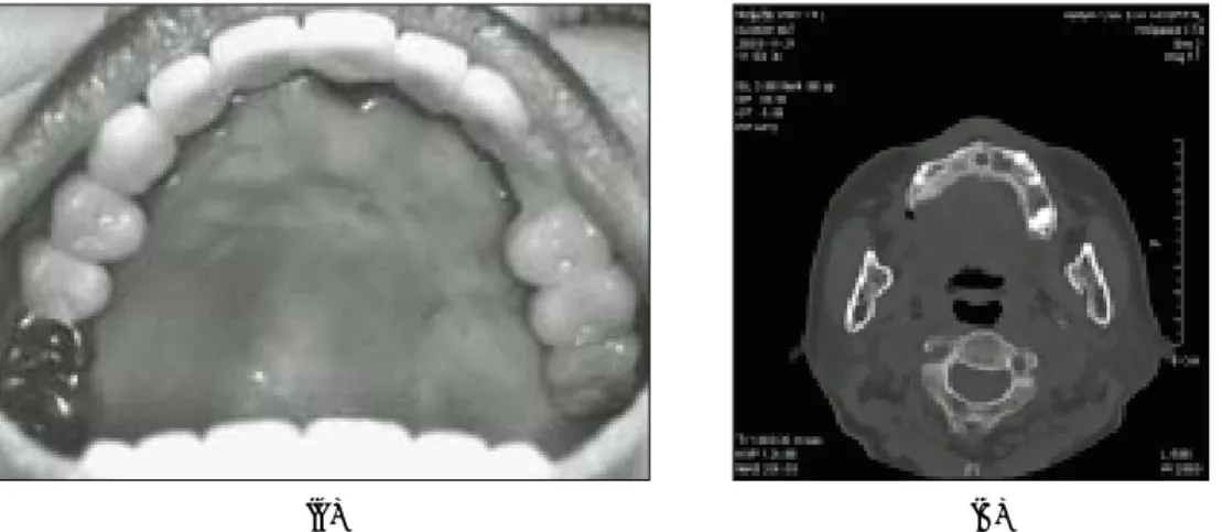 Fig. 5. Follow  up  Image  23  months  later    A.  The  soft  tissue  lesion  showed  well  healing appearance