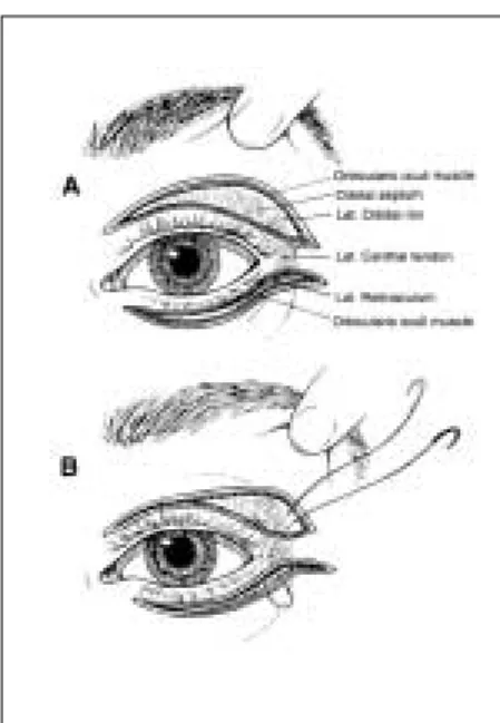 Fig. 1. Technique for gold weight implantation Fig. 2. Technique for suture canthopexy