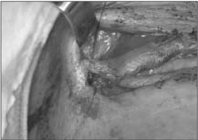 Fig. 7. View of the patient 2 weeks postoperativelyFig. 5.Placement  of  the  implant