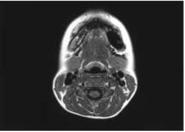 Fig. 1. Interradicular bone resorption state from left mandibular 1 st  premolar to 2 nd molar.