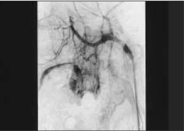 Fig. 5. Transoral  bleeding  state  due  to  locally elevated collateral circulation pressure.