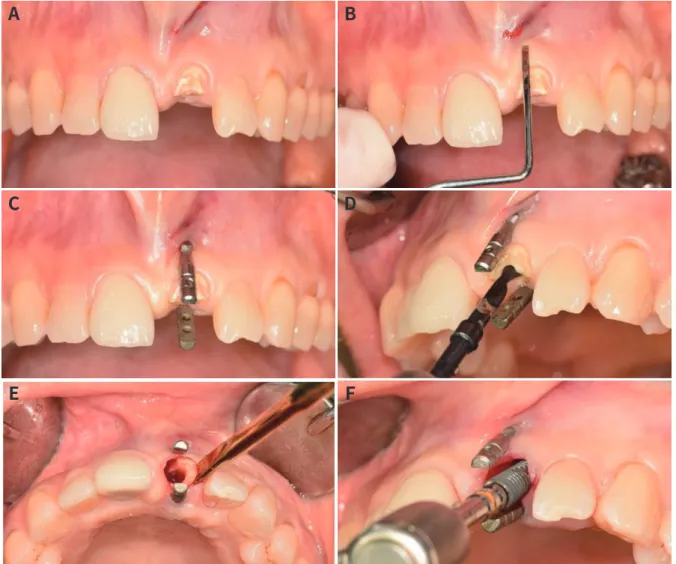 Fig. 1.  (A) Preoperative view of maxillary left central incisal, fractured by secondary caries