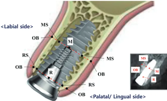 Table 1.  Characteristics of the study group N Number of patients 40 Number of implants 40 Male / female 15 / 25 Age (average) 49.3  Implant location Maxilla 20