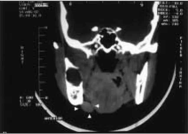 Fig. 2A. Histopathological  profile  of  primary  lesion.