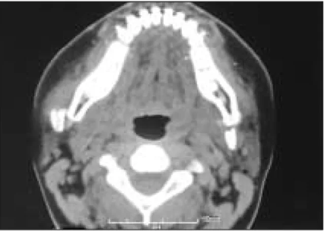 Fig. 3. Panoramic  radiograph  showing  remodeling  of the left proximal fragment 3 months postoperatively.