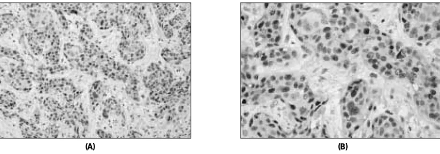 Fig. 6. Photography of p21 expression in squamous cell carcinoma with ×200(A) and ×400(B)
