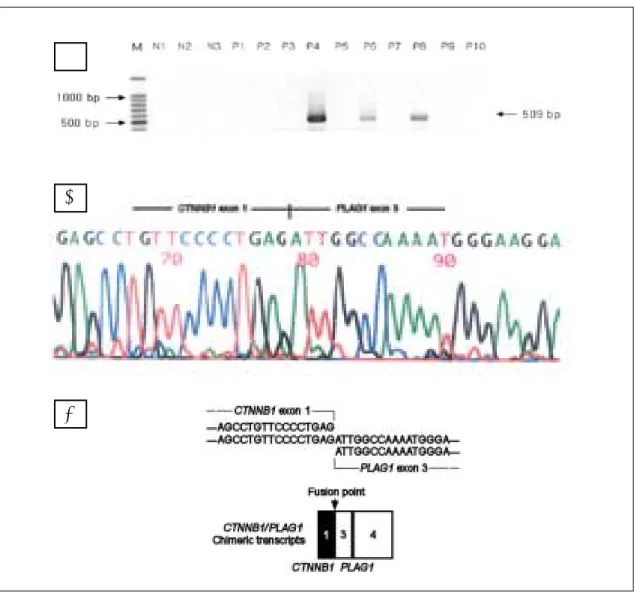 Fig. 2. RT-PCR  analysis  and  sequencing  analysis  of  reciprocal  fusion  transcript  involving  CTNNB1 and PLAG1