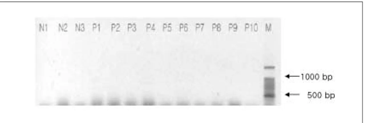 Fig. 3. RT-PCR analysis of reciprocal fusion transcript involving LIFR and PLAG1. An expected 474 or 579 bp  product  was  not  obtained  in  all  of  the  samples