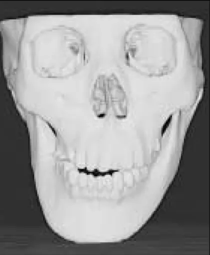 Fig. 2-a. Maxillary  dental  cast  was  mounted  on  3D model  by  face-bow  transfer  (Girrbach � articulator system)