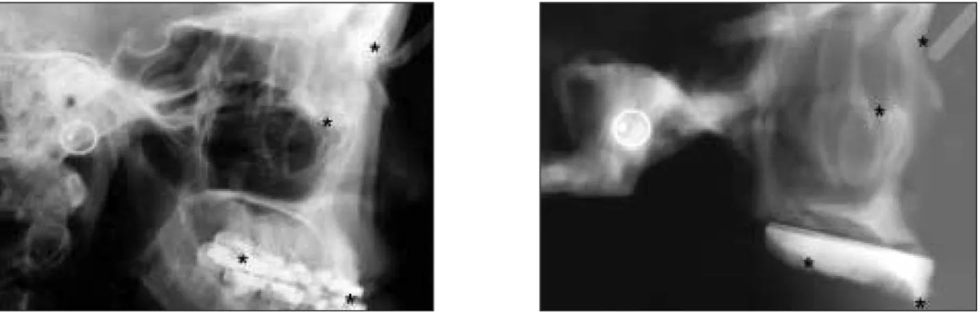 Fig. 3. To evaluate the accuracy, lateral cephalogram were taken from the patient and 3D model integrated with dental cast.