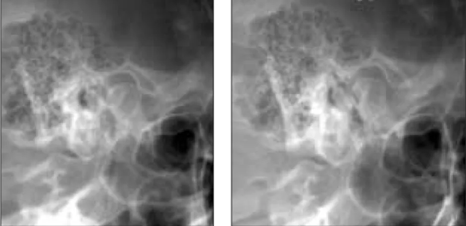 Fig. 6. Transcranial  radiograph  of  right  TMJ  (upper  left:  preo-perative,  upper right:  post-operative)  and  left  TMJ  (lower  left:  pre-operative,  lower  right: