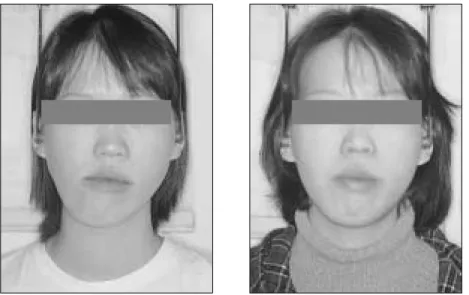 Fig. 7. Pre- and post-operative frontal view of the patient.