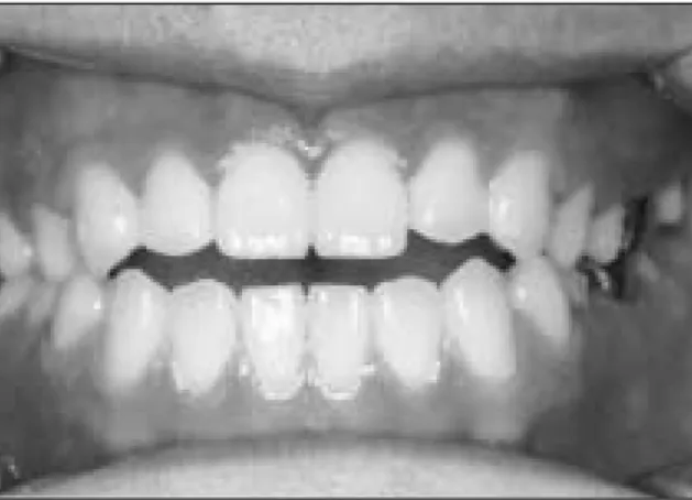 Fig. 2. Lateral cephalogram of pretreatment. It showed Angle class III malocclusion and anterior open bite