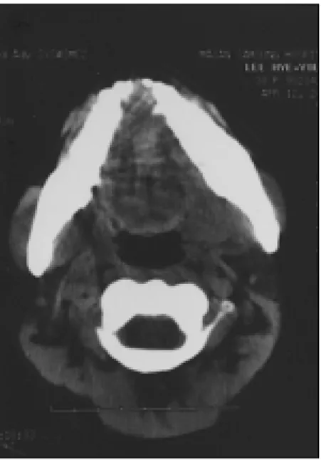 Fig. 5. The resected mass. Fig. 6. H&amp;E  stain.  Note  blunt-ended  nuclei  and  par-