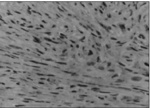 Fig. 8. Immunohistochemical  study  for  α-smooth muscle actin reveals slender and bundle-like strong positivity(×400).