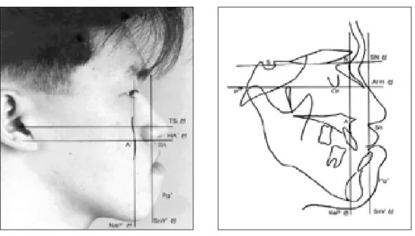 Fig. 1. Example about lateral photograph and lateral cephalograph of patient in Group I  : I군 환자의 예로서 흑백사진상의 심미적 평가에서 A'점이 NaP'선상에 있고(좌측 사진) 방사선 계측 사진의 투사도에서도 A점이 NaP선 상에 위치함(우측 투사도).