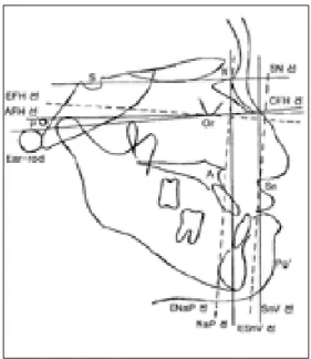 Fig. 2. Example about lateral photograph and lateral cephalograph of patient in Group II 