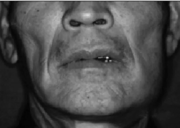 Fig. 1. Preoperative  extraoral  view  showing  swelling  of Lt. Mn. angle area