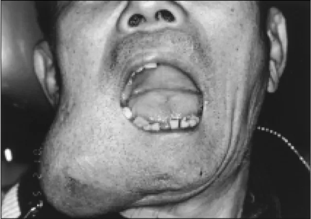 Fig. 2. Buccal expansile mass was isolated and proximal resection line was marked with reciprocating saw.