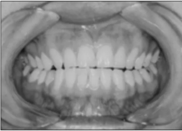 Fig. 1. Preoperative intraoral finding Fig. 2. Preoperative panorama
