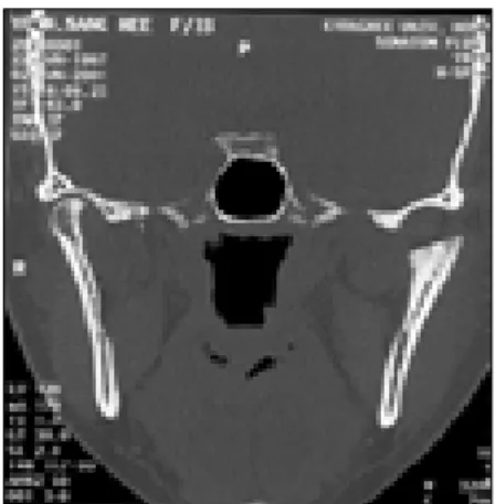 Fig. 7. Postoperative intraoral findings  Fig. 8. Postoperative CT