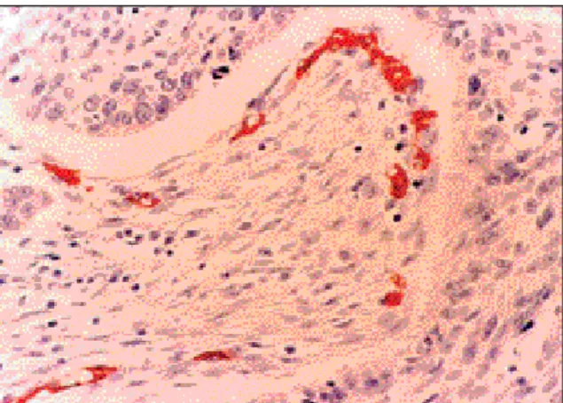 Fig. 5. Immunohistochemical staining for ras in squamous cell carcinoma.