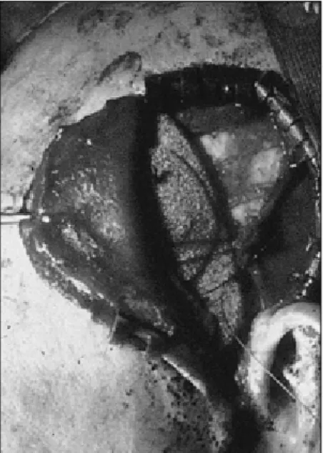 Fig. 2. 구개결손부위에 봉합된 측두근 피판의 모습.