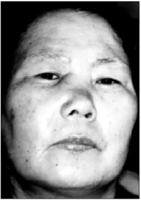 Fig. 8. 골격근(skeletal m.) 들 사이로 림프 소포들이 침윤되