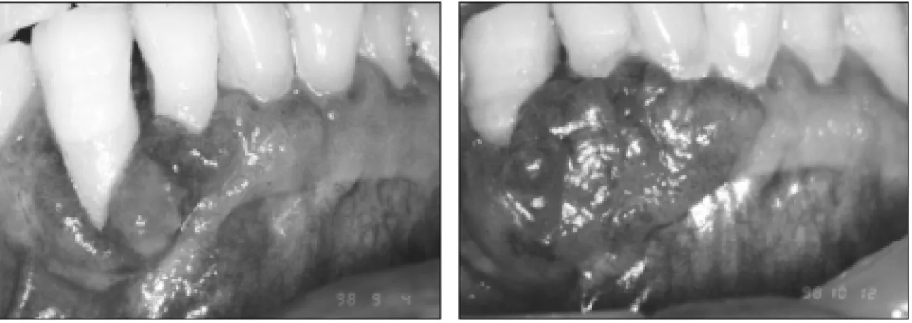 Fig. 1. (Lt) Clinical view of the lesion at 10 days after biopsy.