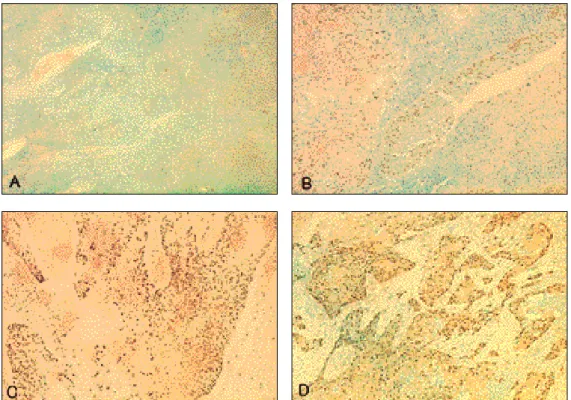 Fig. 1. Staining intensity of p53 in head neck squamous cell carcinoma. A: grade 0, B: grade 1, C: grade 2, D: grade 3