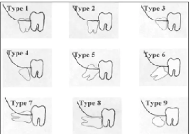 Fig. 1. Classified 9 types of Impacted lower third molar.