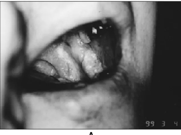 Fig. 1. Photograph of squamous cell carcinoma on the left retromolar triangle (a). There are no sign of bony invasion on bone scan (b), computerized tomographic (CT) scan (c), and conventional radiograph (d)