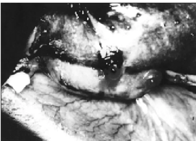 Fig. 1. After  completion  of  the  osteotomy,  the  prefabricated  intraoral distraction  device  was  located  on  the  surface  of  the  buccal  cortical bone and was fixed with 4 titanium mini-screws and 4 micro-screws.