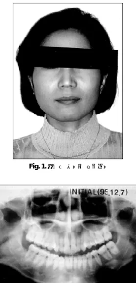 Fig. 3. 개인치과 최초 내원 당시의 panoramic view Fig. 4. 교합장치 장착한 구강내 사진