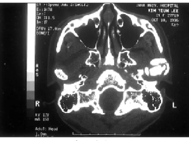 Fig. 7. 수술장면 Fig. 8. 술후 환자의 개구상태