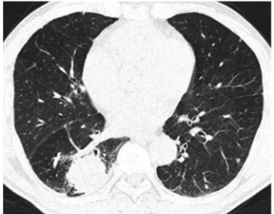 Figure 1. Chest CT scan shows that about 5.2cm sized